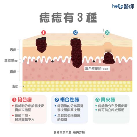 痣為什麼會長毛|為什麼臉上的痣越來越多？皮膚科醫師解析長痣原因、。